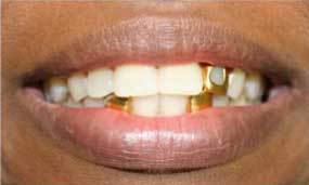 Porcelain Veneers