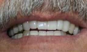 Removable Dentures