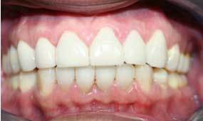 restorative invisalign and crowns, teeth whitening 