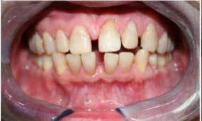 Porcelain Veneers