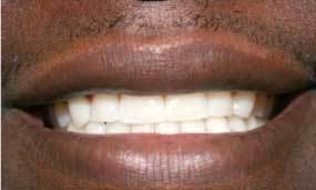 Clear Braces - Invisalign