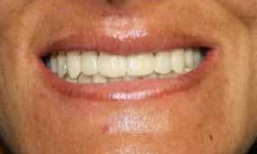 Same Day Porcelain Veneers