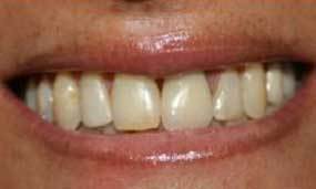 Porcelain Veneers