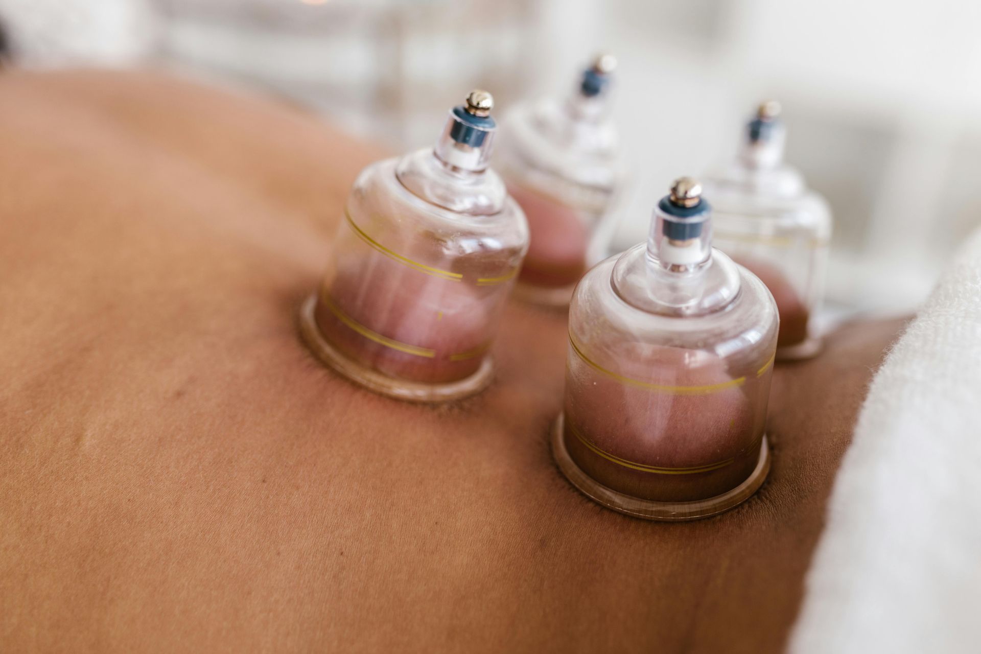Cupping therapy on a person's back; clear cups create suction, turning skin pink.