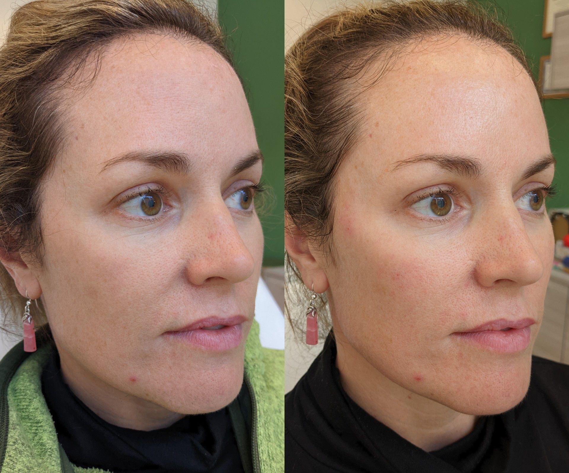 Mid face rejuventation with HA filler