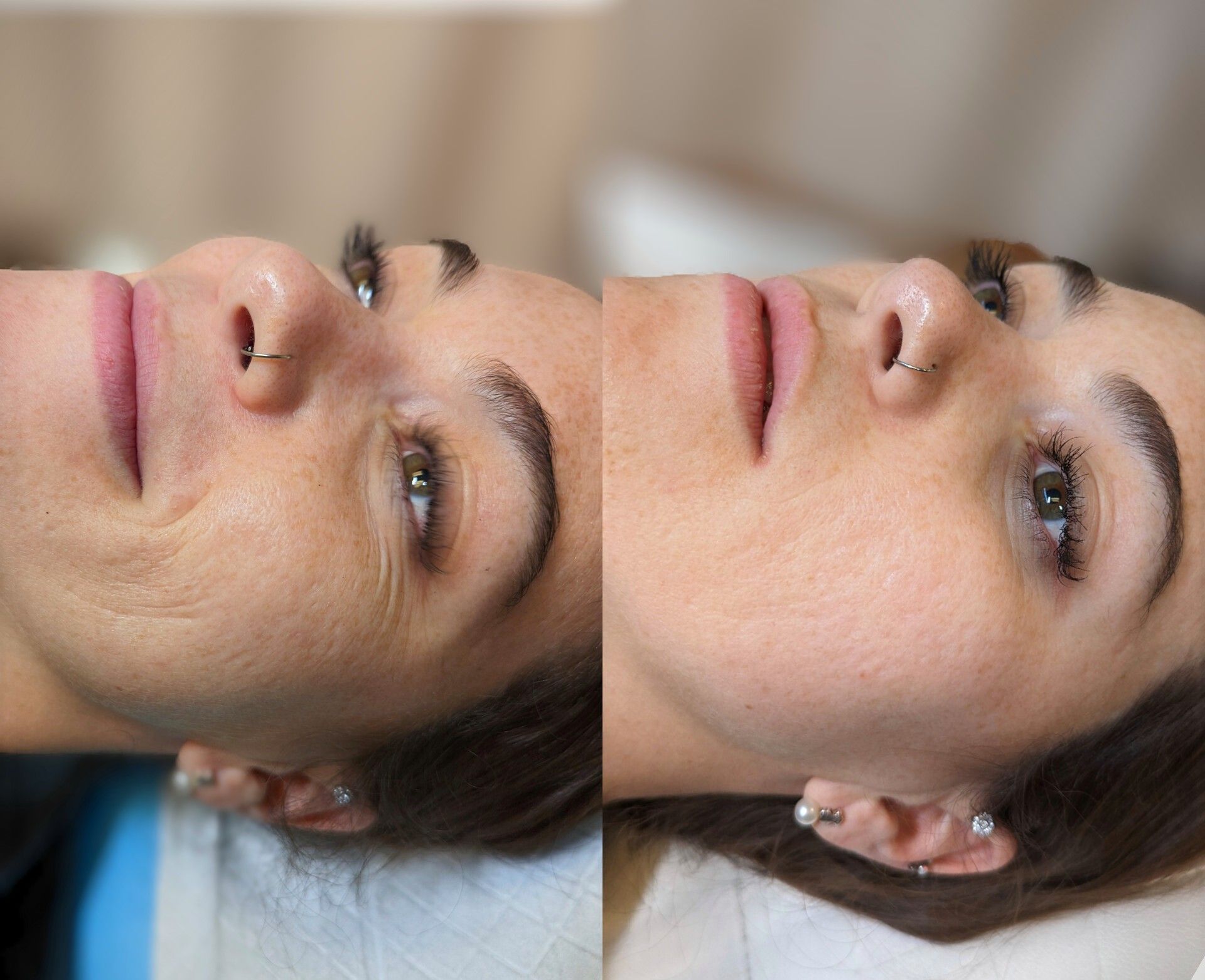 Microneedling before and after