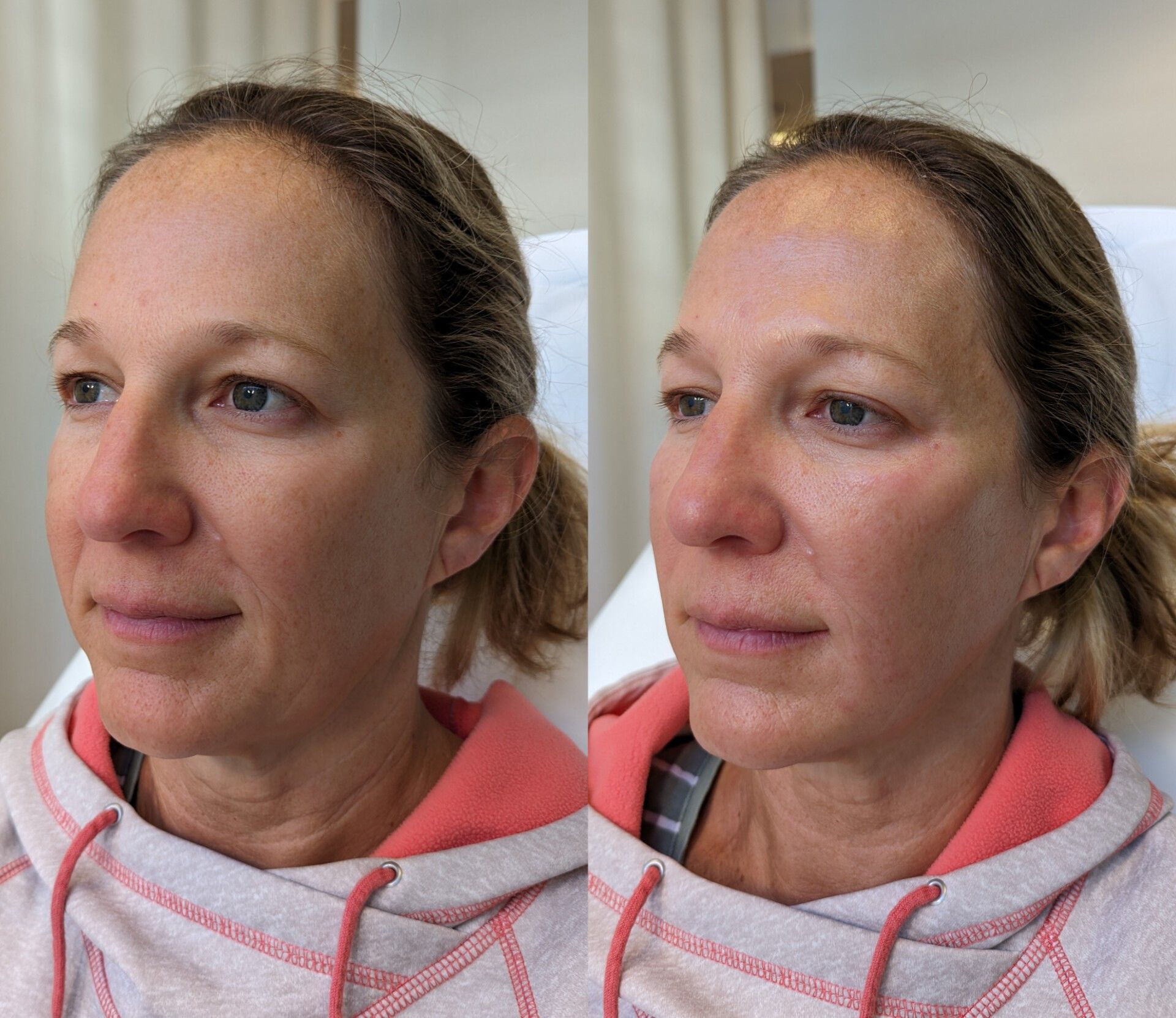 Cheek and smile lines filler