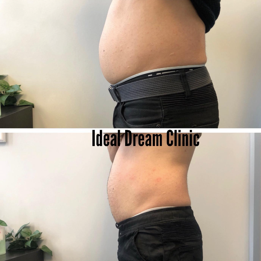 a before and after picture of a man 's stomach from ideal dream clinic