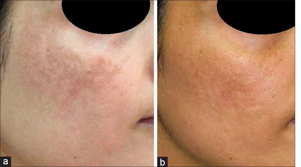 Skin tone changes after Laser Hair Removal