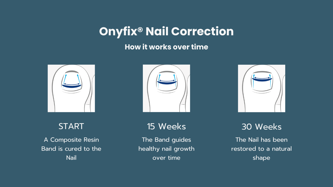 Onyfix treatment chart 