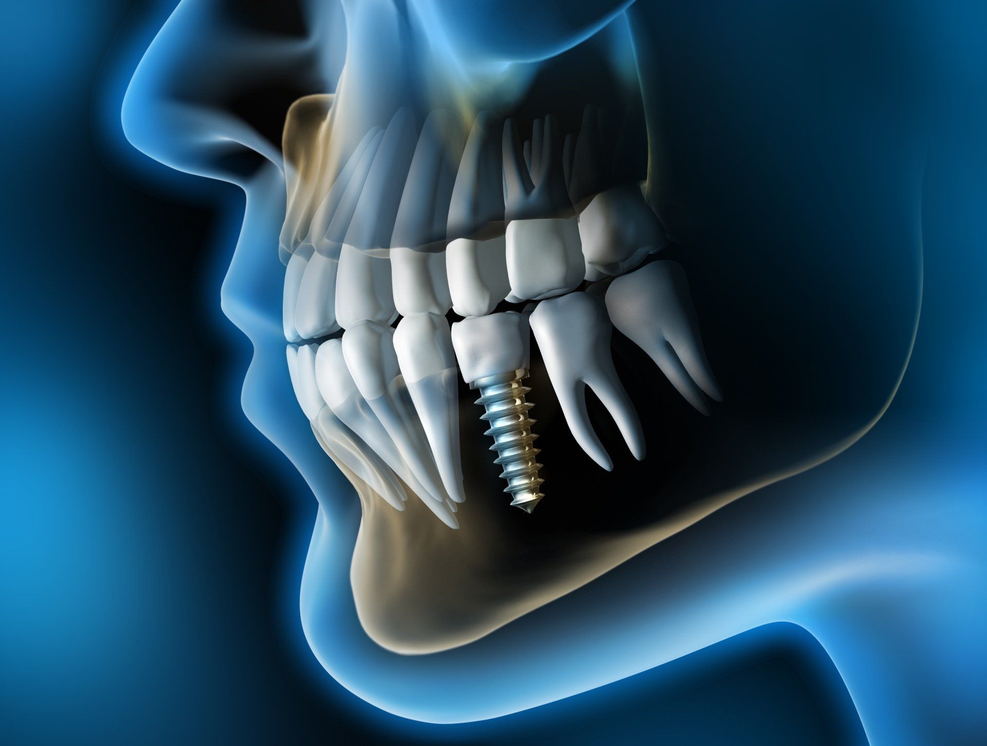 Dentist Implant Model — Parma, OH — Family Dental Care