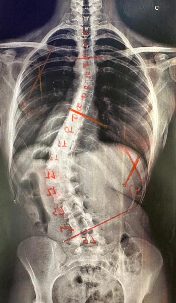 Compreendendo a Cirurgia para Correção da Escoliose