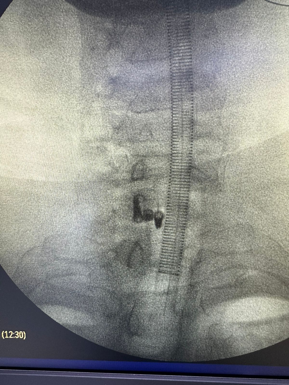 A Jornada de um Procedimento Urgente: Entendendo a Hérnia Cervical