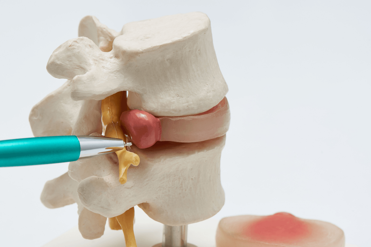 Tratamento Avançado para Hérnia de Disco Cervical: Sintomas, Causas e Soluções