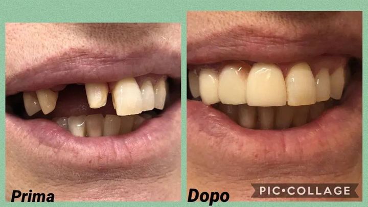 sorriso prima e dopo intervento dentista