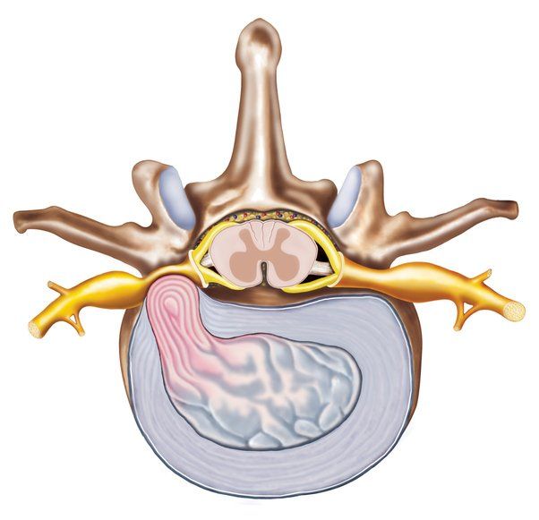 Herniated Disc affecting sciatic nerve