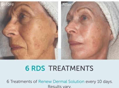 A before and after photo of a woman 's face