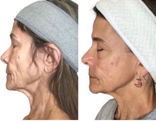 A before and after photo of a woman 's face with a headband and earrings.