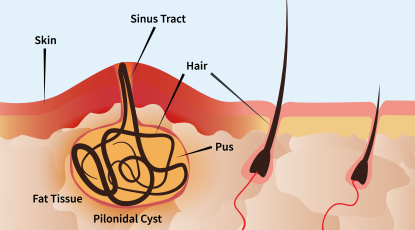 Diagram of a pilonidal cyst in skin showing a pus-filled cyst, sinus tract, hair, and fat tissue.