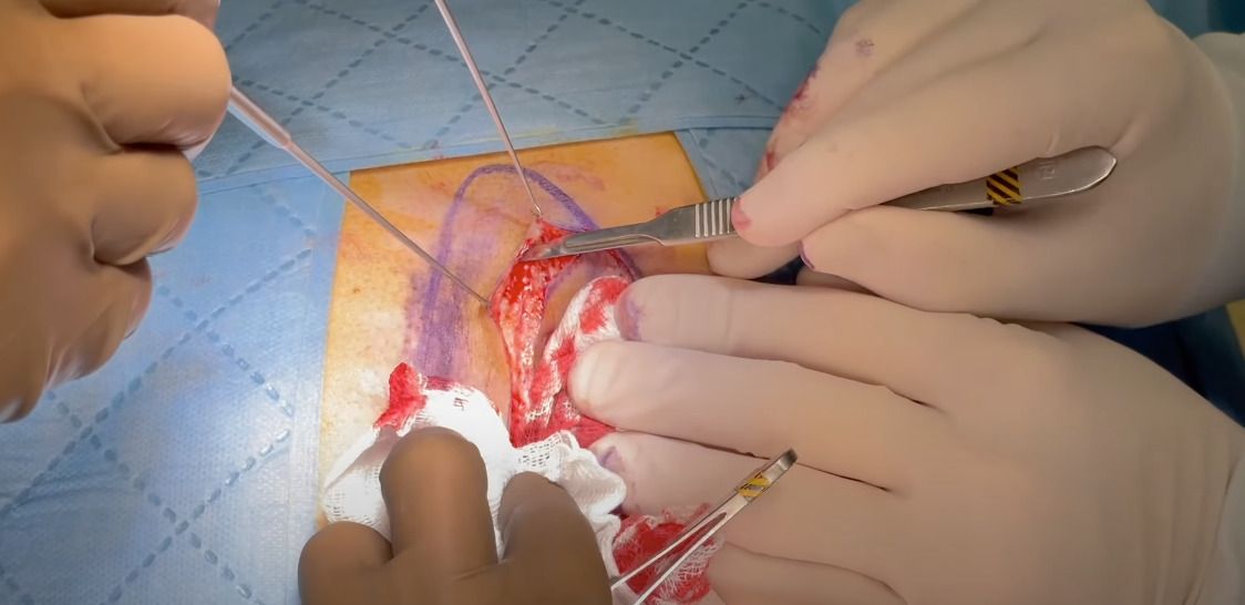 Cleft lift procedure by Dr. John Bascom