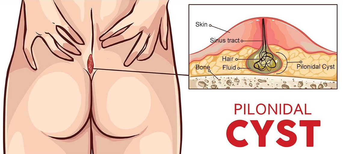 Illustration of a pilonidal cyst on a person's buttocks. Close-up cross-section shows the cyst's structure.