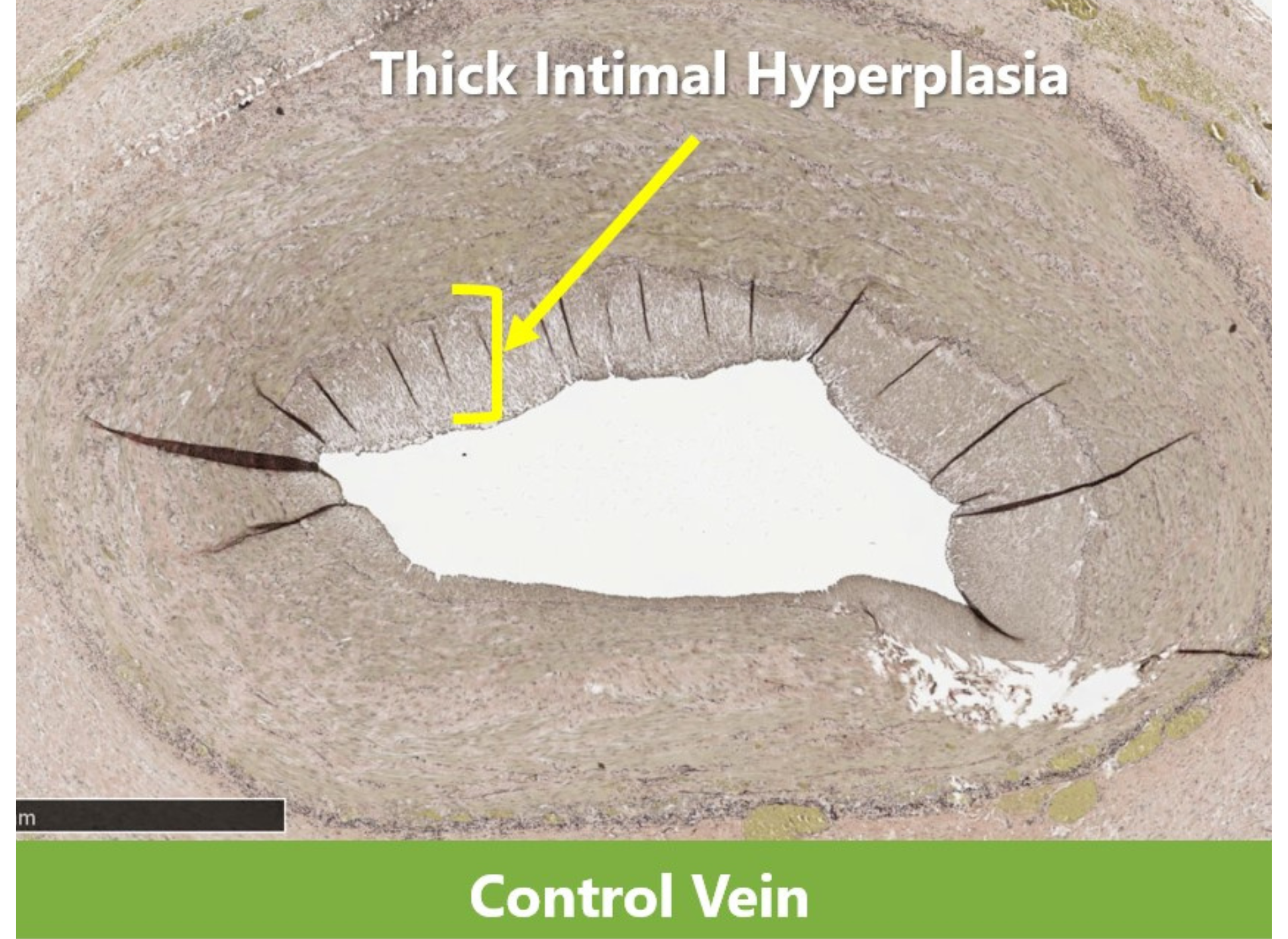 A picture of a thick intimal hyperplasia control vein