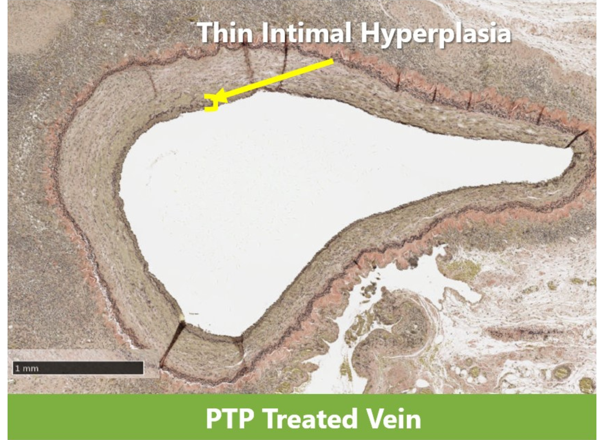 A picture of a thin intimal hyperplasia ptp treated vein