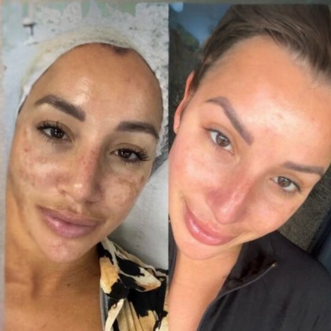 QT Biomicroneedling Behandlung – Eine Kosmetikerin wendet Biomicroneedling an, um das Hautbild bei Akne und aktiver Akne zu verbessern, Entzündungen zu reduzieren und die Hautregeneration zu fördern.