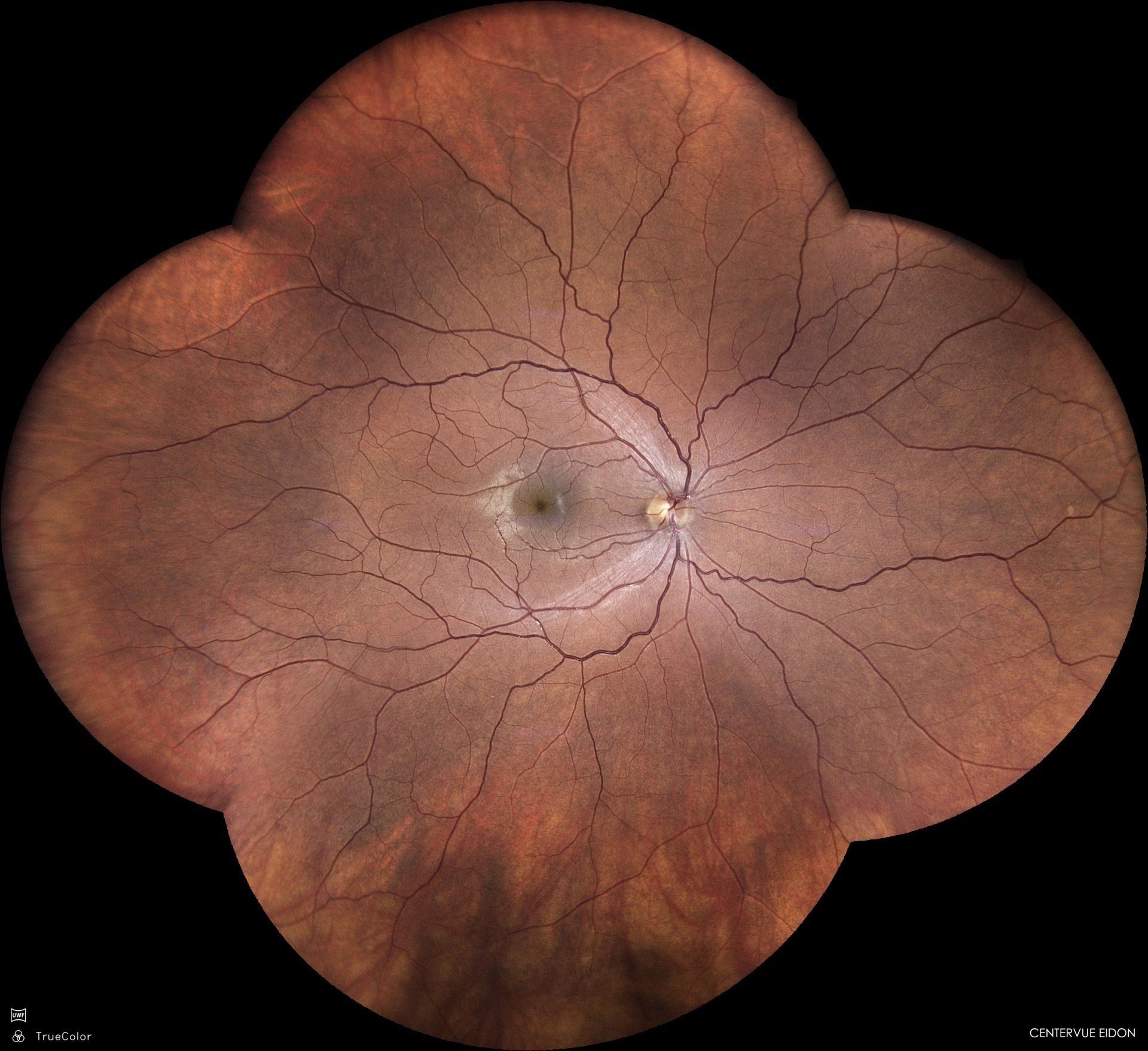Widefield retinal image