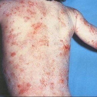 eczema atopico