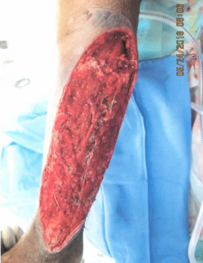 Open wound on a leg, showing exposed tissue. Reddish-brown color, set against a medical environment with blue fabric.