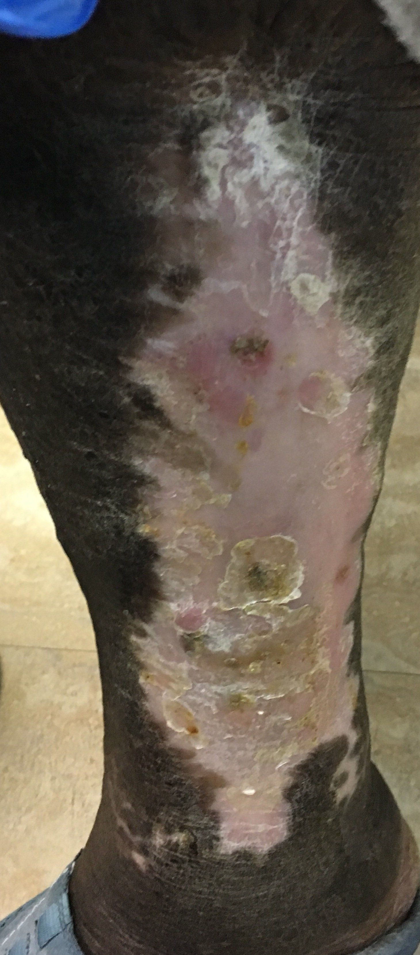 A leg with a skin condition, featuring discolored, scaly patches and areas of exposed skin.