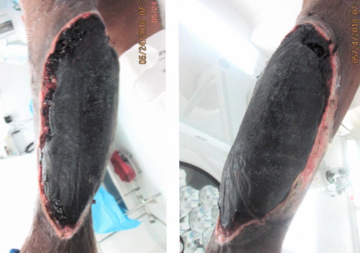 Two views of a leg with a large, dark, necrotic wound. The edges are red, healthy tissue.