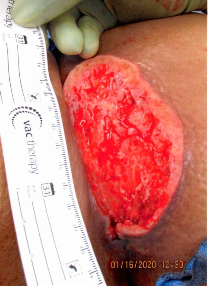 A deep wound on skin, appears red and open. A ruler is held alongside it.