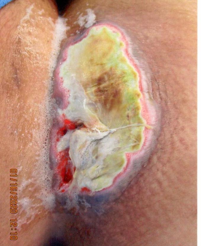 Buttock with large, open, ulcerated wound. Yellow, green, and red discoloration.