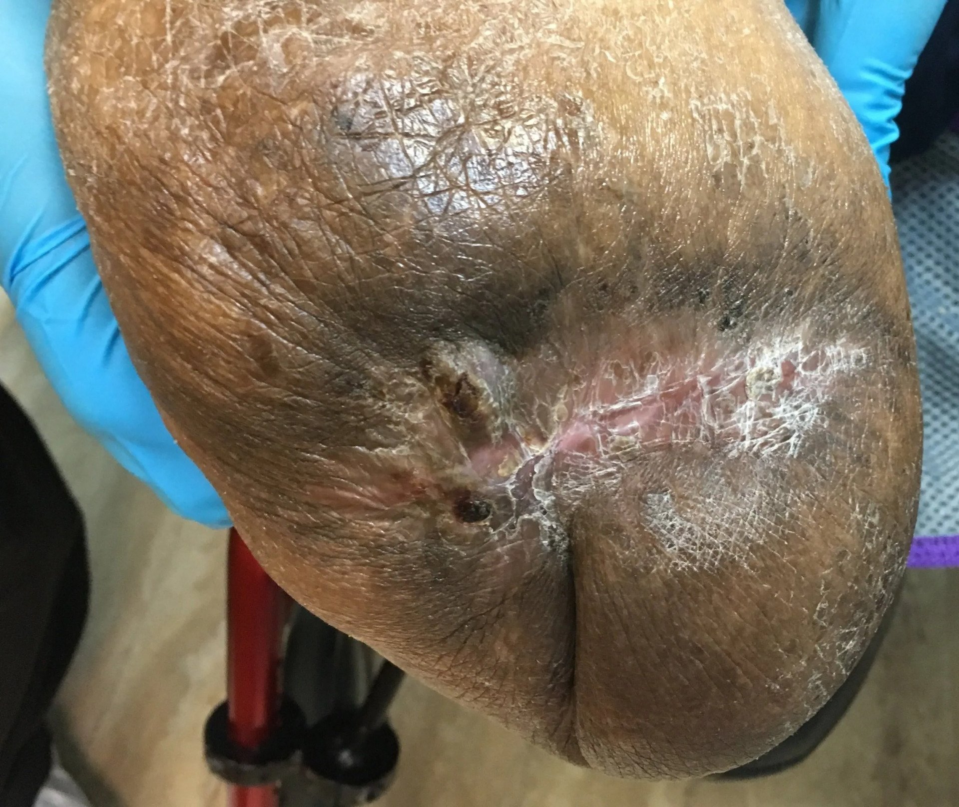 Close-up of a dark-skinned lower leg and foot with a large, healed ulcer and surrounding discoloration.