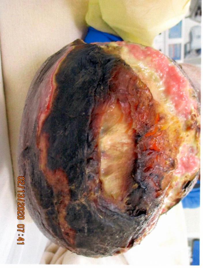 Severe burn injury on skin, showing charred black, reddish, and pale areas.