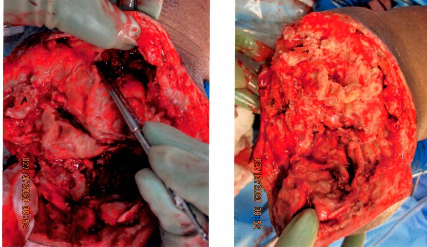Surgical view of a knee with exposed tissue, tools, and red and white coloration, potentially during a medical procedure.