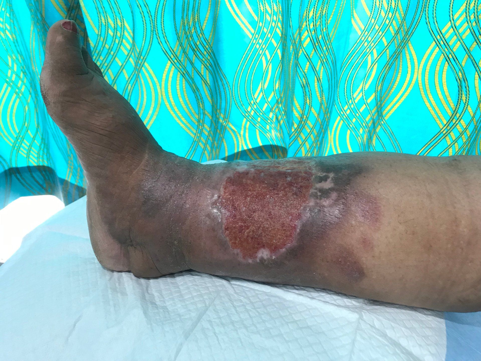 Injured Leg Treatment with Bandage — Jacksonville, FL — Wells Surgical Services LLC