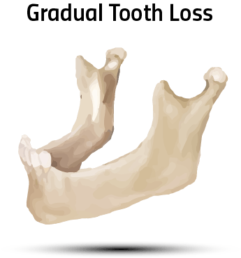 Gradual Tooth loss