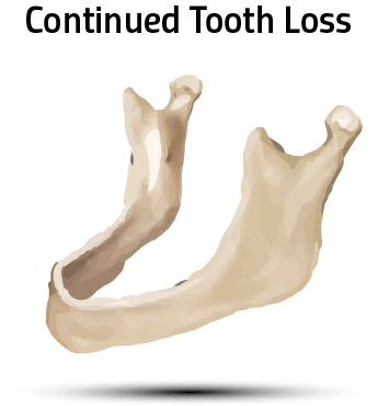 Continued Tooth Loss