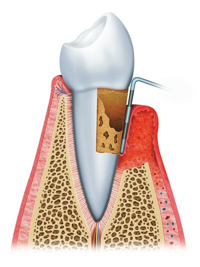 Illustration of advanced periodontitis