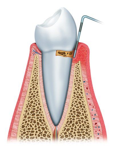 Illustration of Gingivitis
