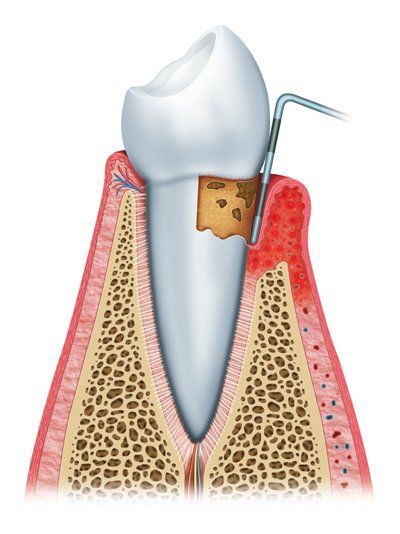 Illustration of Periodontitis