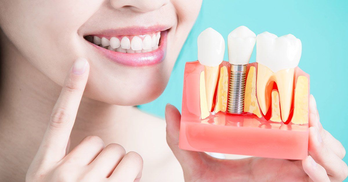 Everything You Need to Know About Dental Implants