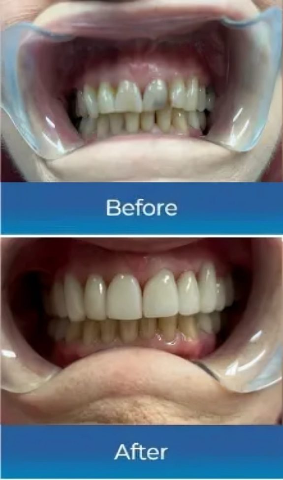 before and after dental veneers