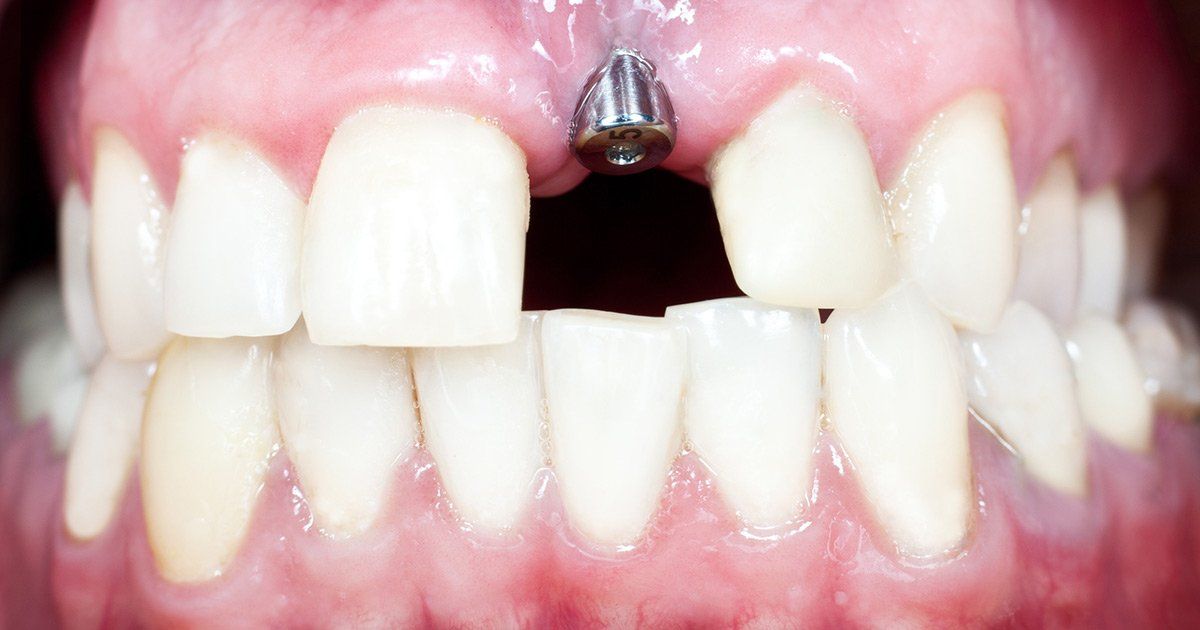 replace missing teeth, Dentist in South Philadelphia PA