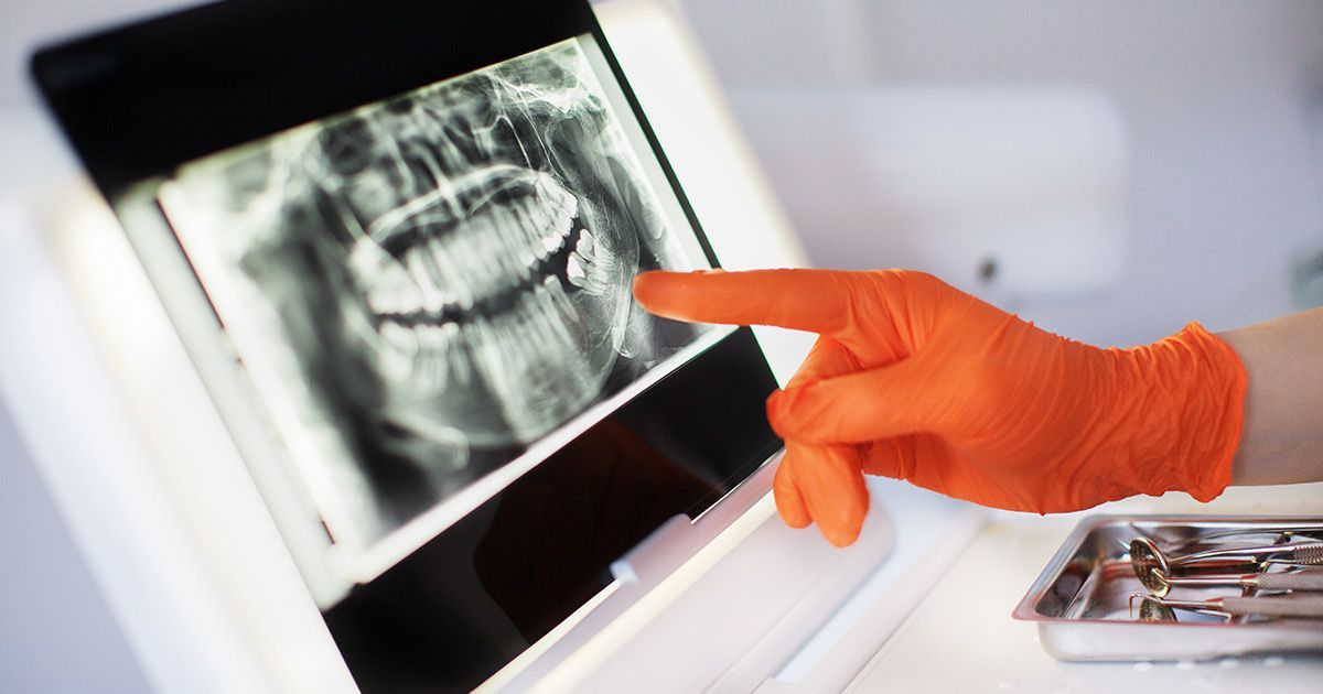 A dentist is pointing at an x-ray of a person 's teeth on a computer screen.