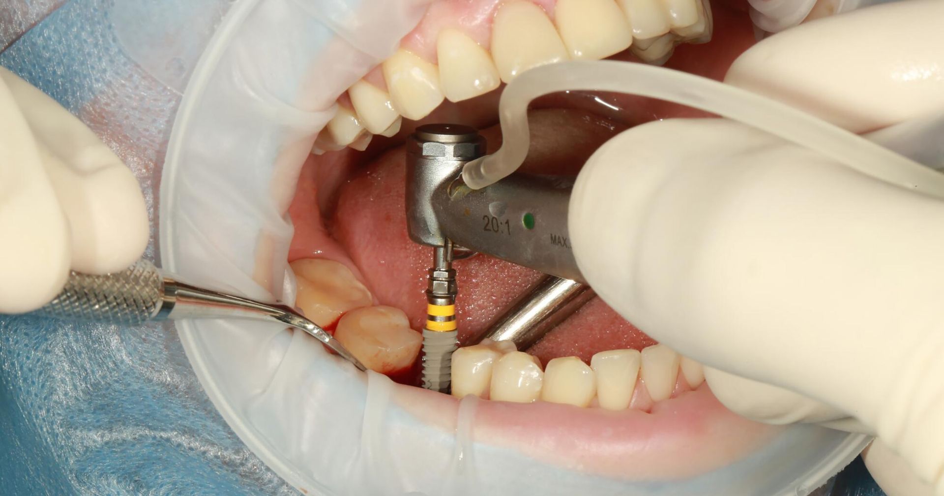 Dental Implants vs bridges
