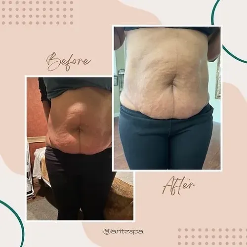 A before and after photo of a woman 's stomach